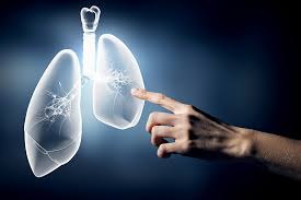 AI Likely To Help In Screening Lung Cancer